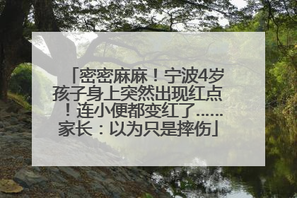 密密麻麻！宁波4岁孩子身上突然出现红点！连小便都变红了……家长：以为只是摔伤